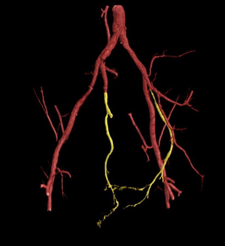 Dreidimensionale Rekonstruktion der Blutgefässe im Becken und im Penis vor der Planung einer allfälligen Therapie.